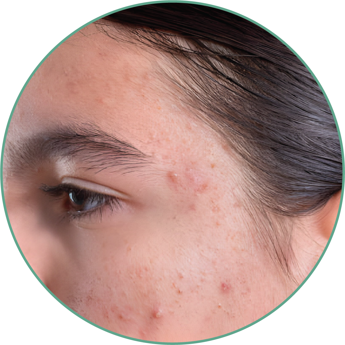 ACNE OILY PRONE acne-oily-prone